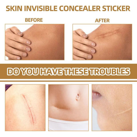 JAYSUING Waterproof Skin Scar Acne Mark Covering Patch, Acne Mark Covering Patch