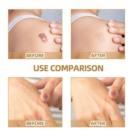 JAYSUING Waterproof Skin Scar Acne Mark Covering Patch, Acne Mark Covering Patch