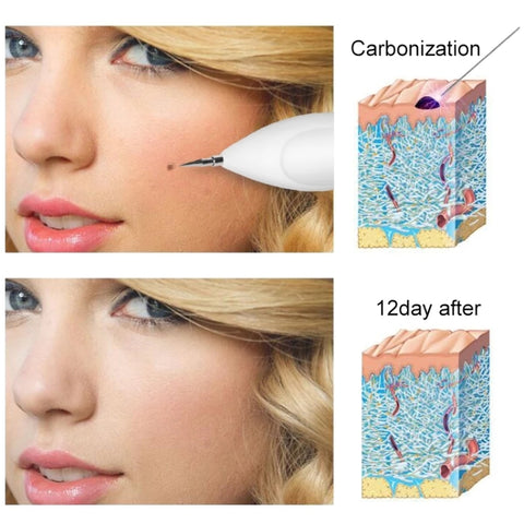 Dark Spot Remover USB Laser Plasma Pen Facial Freckle Wart Removal Beauty Care Device