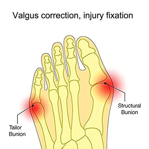 1 Pairs Wearable Shoes Big Toe Valgus Corrector Toe Comfortable Splitter, S, L
