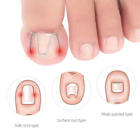 6pcs /Box Ortho Wire Nail Insertion Orthotic Toe Nail Ortho Hooks