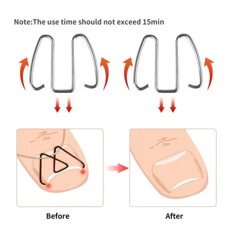 6pcs /Box Ortho Wire Nail Insertion Orthotic Toe Nail Ortho Hooks